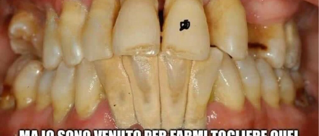 sbiancamento denti Studio Odontoiatrico Scarozza dentista San Giovanni Roma denti bianchi